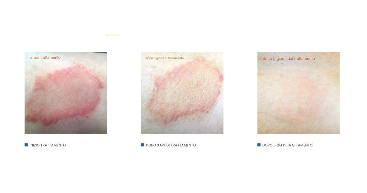 come curare la psoriasi con l'argento colloidale